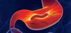 Role of Antibiotics in Treating Ulcers Caused by H. pylori