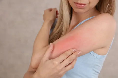 Sensitive Skin in Summer: How to Beat Heat Rashes & Allergic Reactions