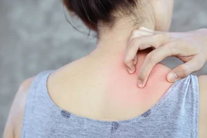 How to Treat a Sudden Rash or Allergic Reaction