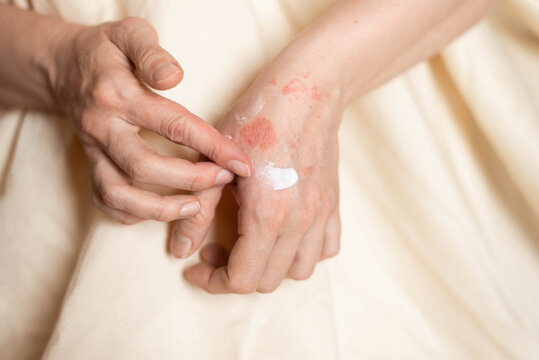 Skin Rashes, Eczema, and Dermatitis