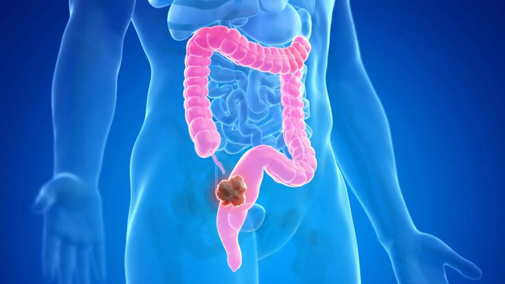 The Role of Preventive Healthcare in Encouraging Regular Colorectal Cancer Screening
